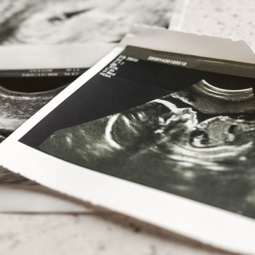 Photographs of ultrasound of pregnancy at 4 weeks and 20 weeks of pregnancy Selective focus.